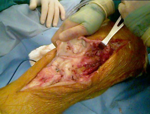 Knee Scar Tissue